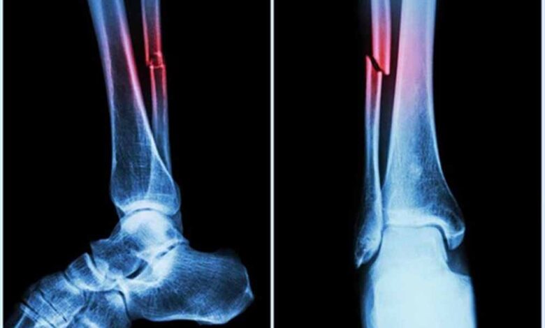 NIT की रिसर्च: हड्डियों की मरम्मत के लिए प्रोटीन से नए उपचार के रास्ते