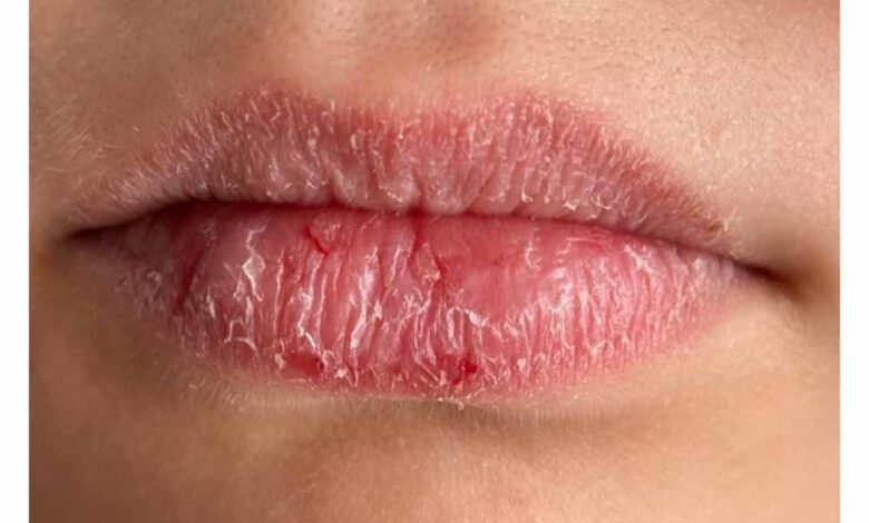 रूखे-होंठों-की-समस्या?-किचन-की-ये-चीजें-वापस-लाएंगी-निखार