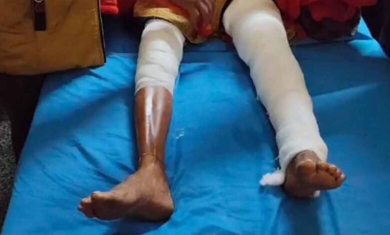 ऑपरेशन-में-लापरवाही!-इलाज-के-बाद-छोटा-हो-गया-मरीज-का-पैर,-आयोग-ने-दिया-3-लाख-का-मुआवजा