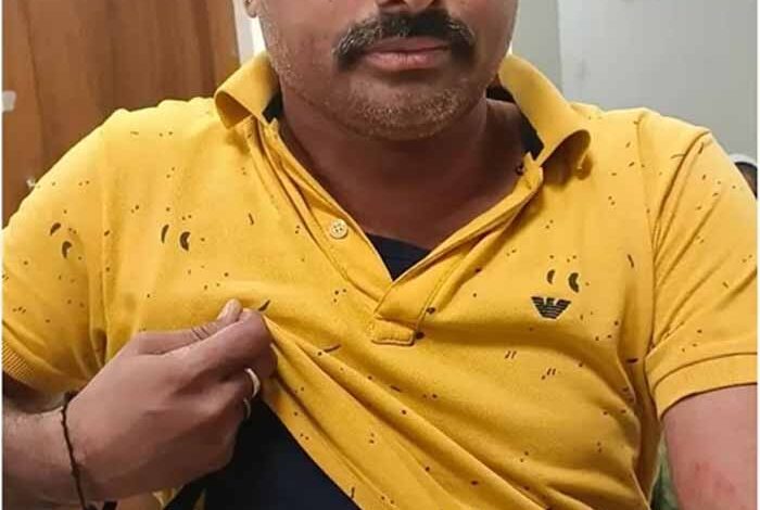 रतलाम-में-sir-सर्वे-टीम-पर-पथराव:-नायब-तहसीलदार-ब्लो-पर-हमला,-दो-आरोपी-दबोचे