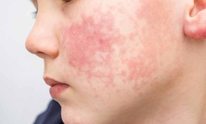 kidney-alert:-ड्राई-और-खुजली-वाली-त्वचा-दे-रही-है-खतरे-का-संकेत,-डॉक्टर-बोले–-तुरंत-कराएं-जांच