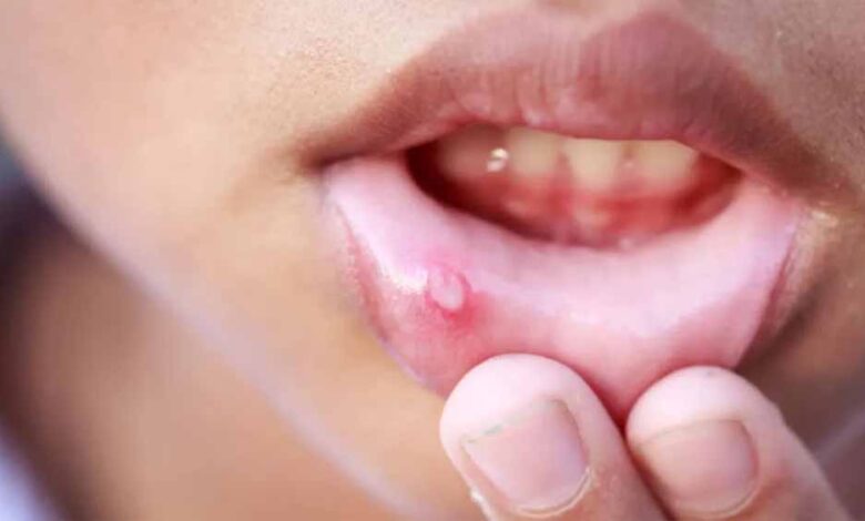 मुंह-के-छालों-से-राहत-पाने-के-आसान-और-असरदार-घरेलू-उपाय