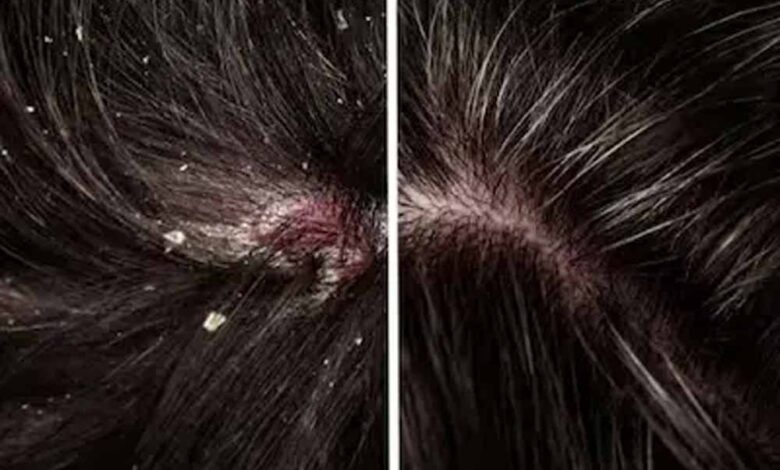 डैंड्रफ-नहीं,-स्कैल्प-की-गंभीर-समस्या-भी-हो-सकती-है!-तेल-लगाने-से-पहले-जान-लें-ये-सच्चाई